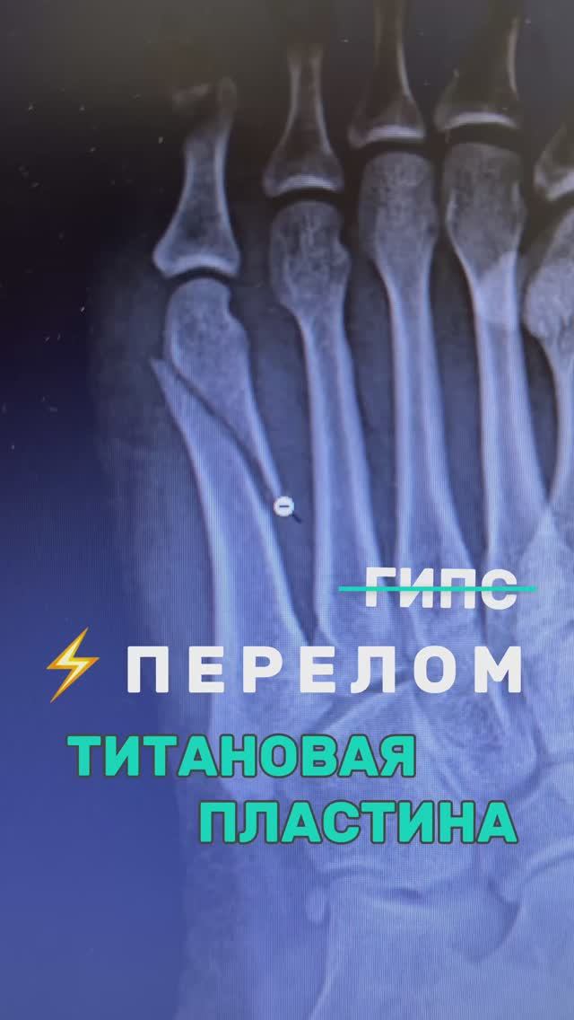 ⚡️Перелом 5й плюсневой кости. ЛД Медицина