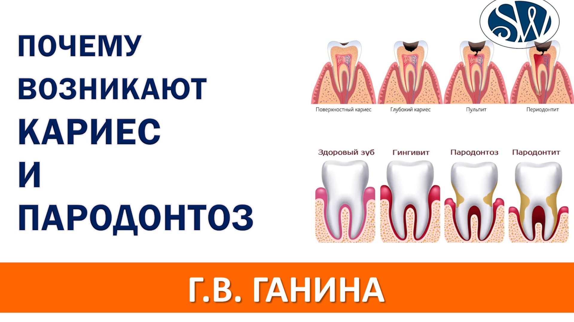 Почему возникает кариес и пародонтоз
