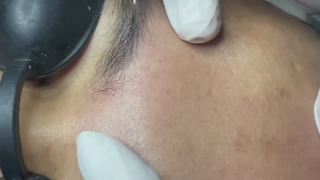 Нос в сальных нитях и черных точках — смотрим чистку