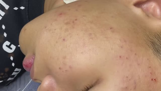 101 • Acne Collection • АСМР • Relax Spa