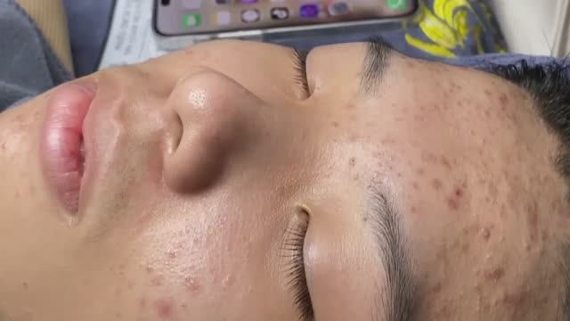 Прыщи уходят отлично. Очищение лица.