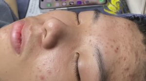 Прыщи уходят отлично. Очищение лица.