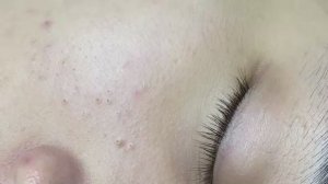 104 • Acne collection • АСМР • Relax Spa