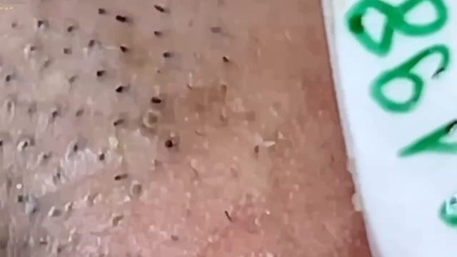 #290 Чистка лица от угрей и акне. Выдавливание прыщей. Удаление черных точек и комедонов