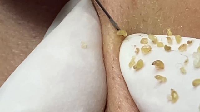 Кожа в сальных нитях и черных точках — смотрим чистку