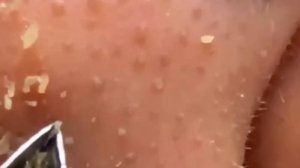 #291 Чистка лица от угрей и акне. Выдавливание прыщей. Удаление черных точек и комедонов