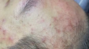 097 • Acne collection • АСМР • Relax Spa