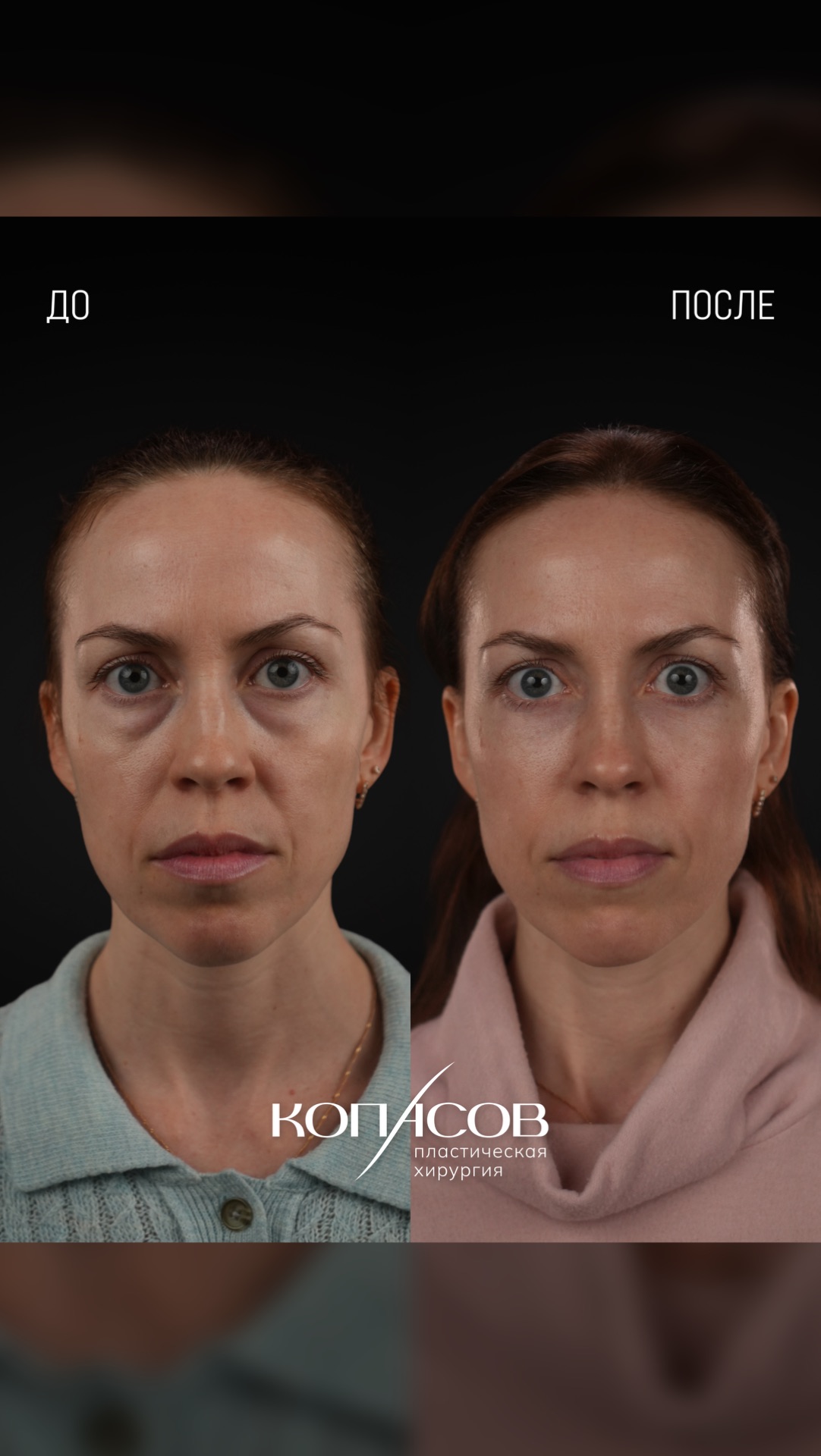 Мне не нравятся мои мешки и синяки под глазами!