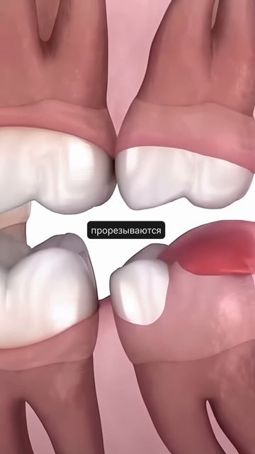 3 причины удалить зуб мудрости