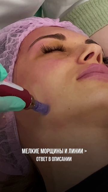 Ответ — фракционная мезотерапия!