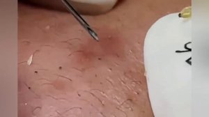 Выдавливание прыщей, угрей, черных точек и камедонов #388