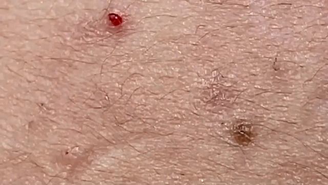 Прыщи уходят отлично. Очищение лица.