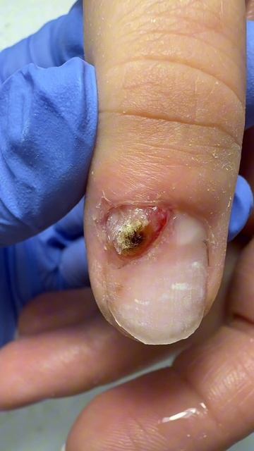 Бытовая травма ногтя, решение проблемы без боли