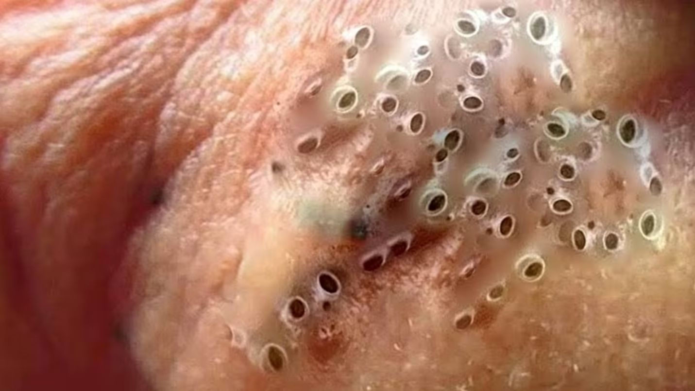 Бодрящая процедура очистки лица от угрей в шикарном спа-салоне