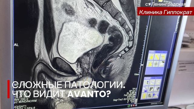 МРТ малого таза у мужчин: от сложных патологий до Pi-RADS на Siemens Avanto в клинике Гипппократ