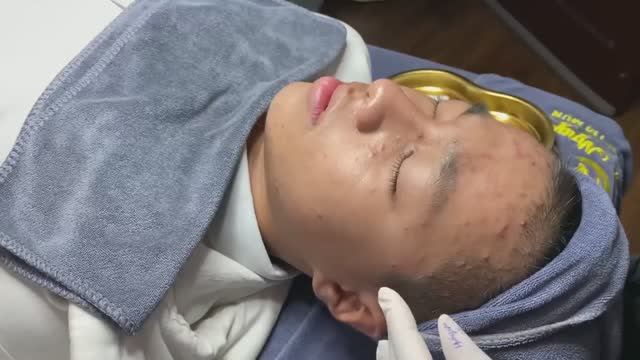 Удаление комедонов на очень проблемной коже