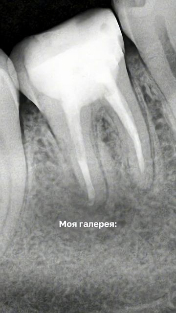 Смотрите больше видео на нашем канале #стоматологмосква #стоматолог #лечениезубов