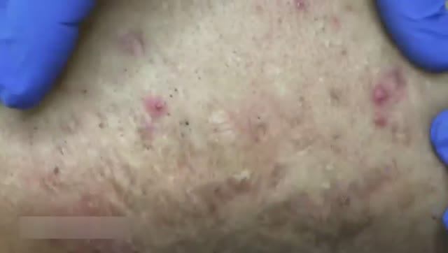 Удаление прыщей на спине