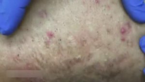 Удаление прыщей на спине