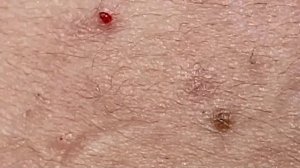 Прыщи уходят отлично. Очищение лица.