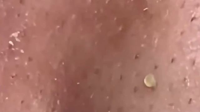 #293 Чистка лица от угрей и акне. Выдавливание прыщей. Удаление черных точек и комедонов