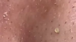 #293 Чистка лица от угрей и акне. Выдавливание прыщей. Удаление черных точек и комедонов