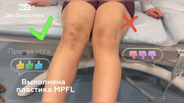 Вывих надколенника. Пластика MPFL.