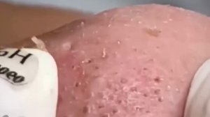 #295 Чистка лица от угрей и акне. Выдавливание прыщей. Удаление черных точек и комедонов