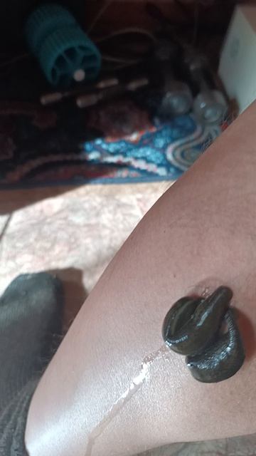 Ставлю себе пиявки