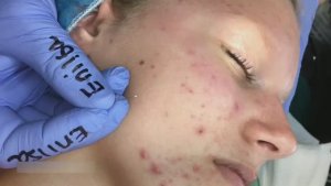 Экстракция акне у подростка