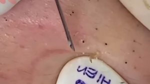 #294 Чистка лица от угрей и акне. Выдавливание прыщей. Удаление черных точек и комедонов