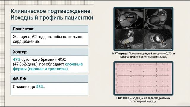 Ранолазин победил тяжелую аритмию (аритмогенный пролапс митрального клапана - aMVP)