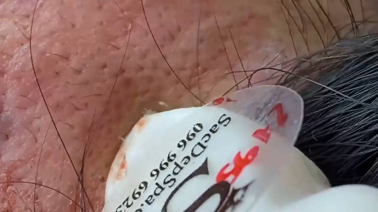 Выдавливание прыщей, угрей, черных точек и камедонов #391