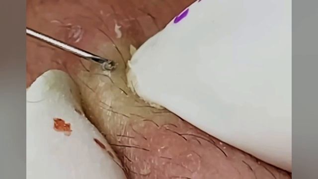 Выдавливание прыщей, угрей, черных точек и камедонов #393