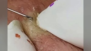 Выдавливание прыщей, угрей, черных точек и камедонов #393