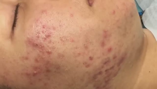 Чистка пор у Лесли от комедонов