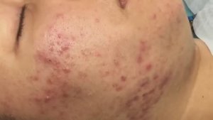 Чистка пор у Лесли от комедонов