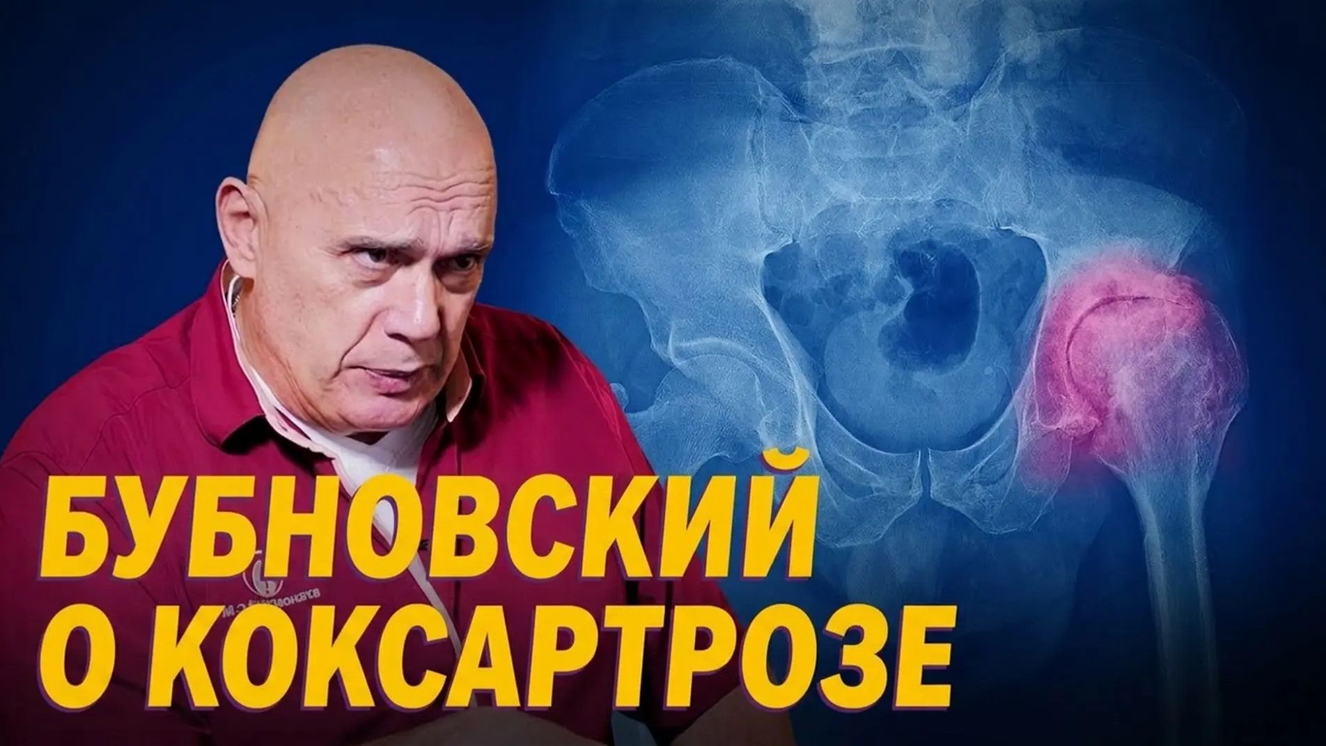 Метод Доктора Бубновского при КОКСАРТРОЗЕ- заболевание тазобедренного сустава