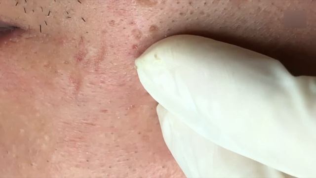 Черные точки и акне. Стоит дотронуться до кожи — и куча прыщей вылетает