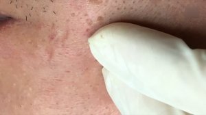 Черные точки и акне. Стоит дотронуться до кожи — и куча прыщей вылетает