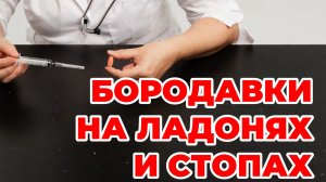 Бородавки на ладонях и стопах. Шипица. Папилломы. Доктор Лисенкова