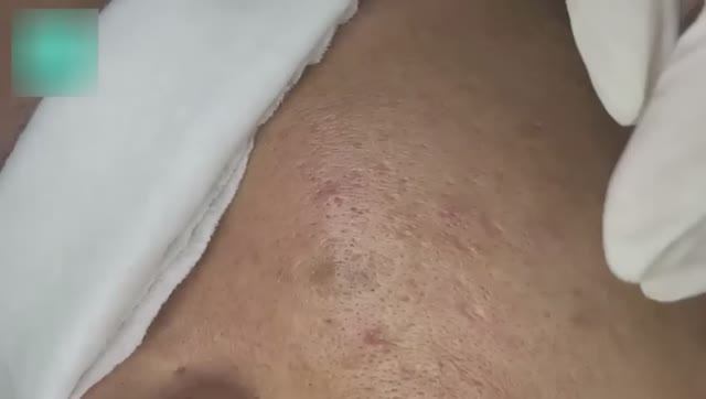 Очищение кожи от подкожных угрей.