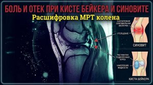 БОЛЬ в колене (ОТЕК) при СИНОВИТЕ колена с КИСТОЙ Бейкера на расшифровке МРТ коленного сустава
