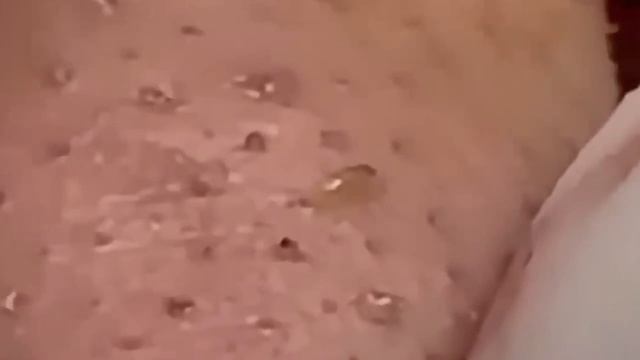 #297 Чистка лица от угрей и акне. Выдавливание прыщей. Удаление черных точек и комедонов