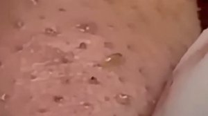 #297 Чистка лица от угрей и акне. Выдавливание прыщей. Удаление черных точек и комедонов