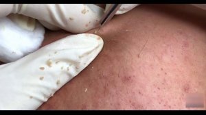 Новое видео по удалению черных точек