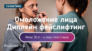 Омоложение лица после похудения −30 кг | Диплейн фейслифтинг у Ларисы Моураовой