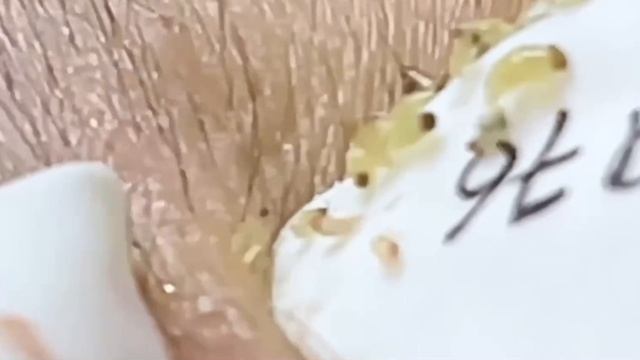 #298 Чистка лица от угрей и акне. Выдавливание прыщей. Удаление черных точек и комедонов