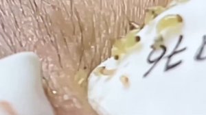 #298 Чистка лица от угрей и акне. Выдавливание прыщей. Удаление черных точек и комедонов