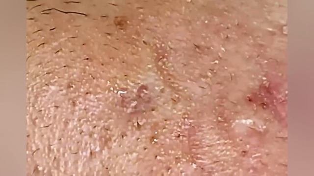 Выдавливание прыщей, угрей, черных точек и камедонов #396